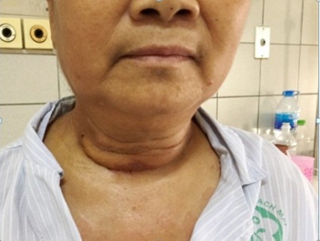 buou giap khong lo chui sau vao long nguc cu ba suot 10 nam gay kho tho nang