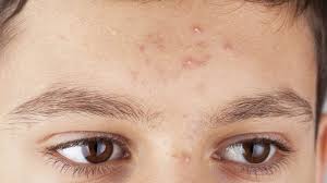 cách chữa mụn nhọt bằng lá ớt
