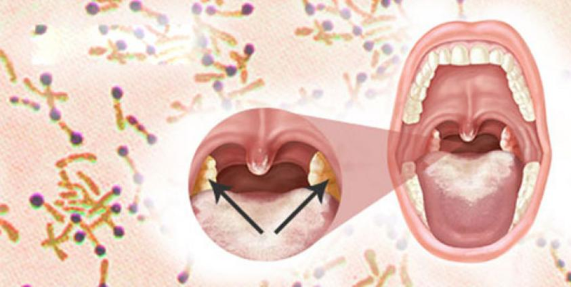 Bệnh bạch hầu lây qua đường nào, có thể lây cả khi ủ bệnh