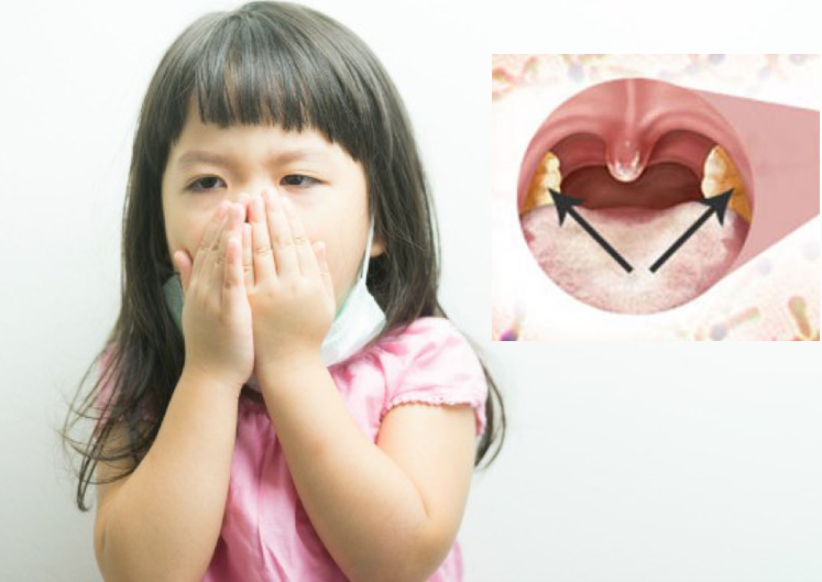 Bệnh bạch hầu lây qua đường nào, có thể lây cả khi ủ bệnh
