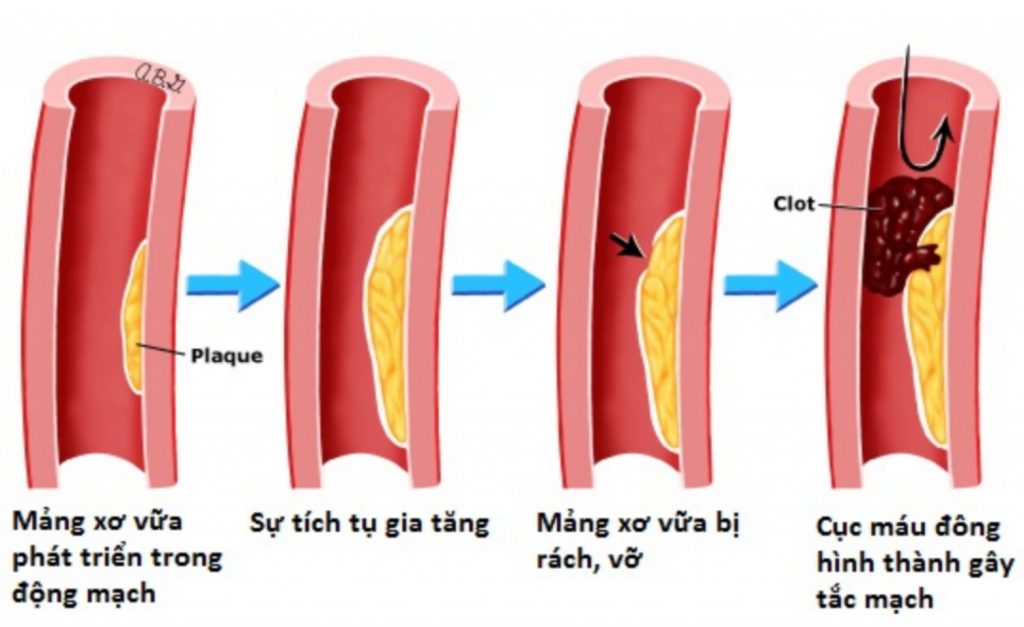 Bệnh viện Việt Đức khám và tư vấn miễn phí bệnh động mạch vành