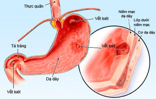 Tình trạng hẹp môn vị gây phù nề, co thắt tại vị trí cơ môn vị Biến chứng không thể coi thường của bệnh đau dạ dày