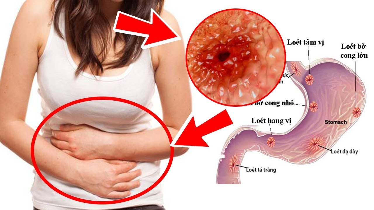 Bệnh dạ dày mang lại nhiều biến chứng lớn Biến chứng không thể coi thường của bệnh đau dạ dày