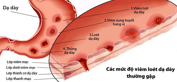 Hình ảnh minh họa mức độ viêm loét dạ dày thường gặp Biến chứng không thể coi thường của bệnh đau dạ dày