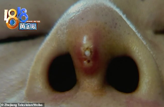 Biến chứng nâng mũi bằng sụn nhân tạo và cách khắc phục Biến chứng nâng mũi bằng sụn nhân tạo và cách khắc phục