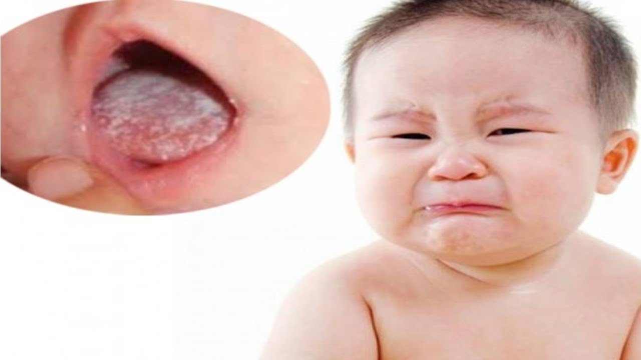 Trẻ bị nấm miệng cha mẹ chớ chủ quan Bác sĩ nói gì việc sử dụng chanh mật ong đối với trẻ tưa lưỡi dưới 12 tháng tuổi
