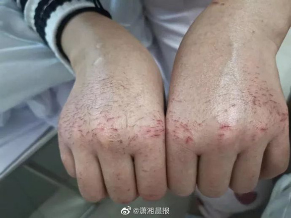 Cảm động nữ y tá không ăn uống, nhịn vệ sinh làm việc suốt 12 tiếng cứu bệnh nhân nhiễm virus coron