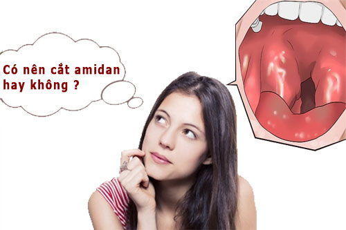 Cắt amidan có đau không? Cắt amidan giá bao nhiêu? 