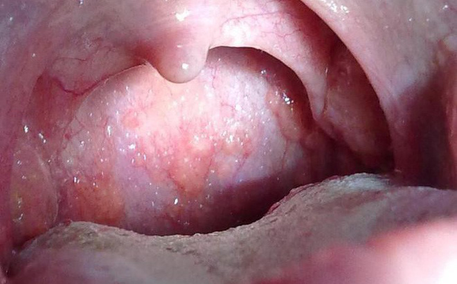 Cây lược vàng có chữa được ung thư không?