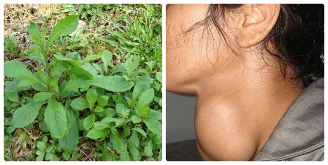 Phương pháp chữa bướu cổ không cần phẫu thuật