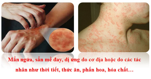 Bài thuốc Đông y chữa chứng dị ứng