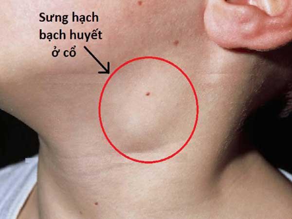 Dạng ung thư máu MC Diệu Linh mắc phải dù là thể mạn tính nhưng vì sao lại gây tử vong nhanh? Dạng ung thư máu MC Diệu Linh mắc phải dù là thể mạn tính nhưng vì sao lại gây tử vong nhanh?Dạng ung thư máu MC Diệu Linh mắc phải dù là thể mạn tính nhưng vì sao lại gây tử vong nhanh?