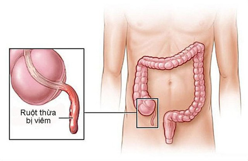 Đau hố chậu phải là bệnh gì? Khi nào là nguy hiểm Đau hố chậu phải là bệnh gì? Khi nào là nguy hiểm