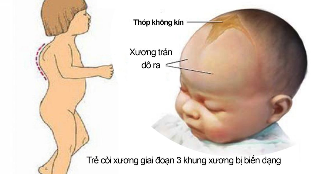 Trẻ còi xương: Dấu hiệu và những sai lầm chữa bệnh cha mẹ chớ coi thường