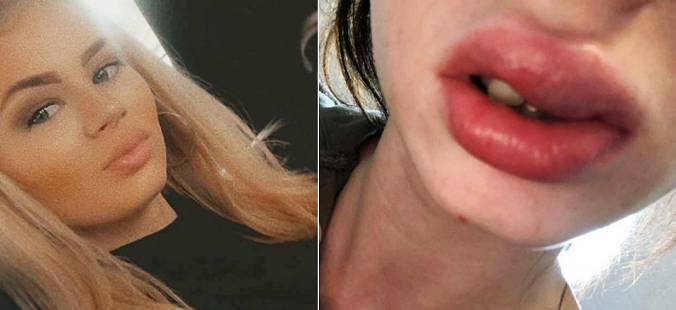 Đôi môi sưng vù, nhiễm trùng máu do biến chứng tiêm filler