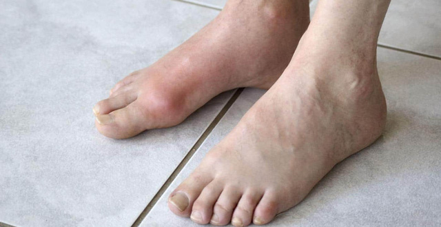 Gout có được uống nước cam không Gout có được uống nước cam không