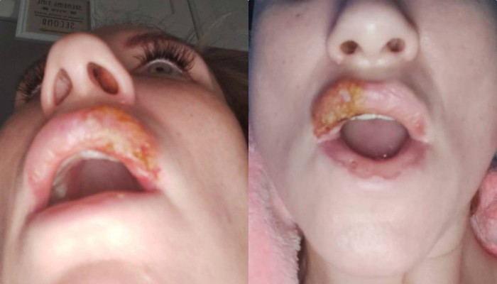 Ham hố tiêm filler cho đôi môi dầy quyến rũ, nào ngờ biến chứng 2 năm trời không thể ăn uống