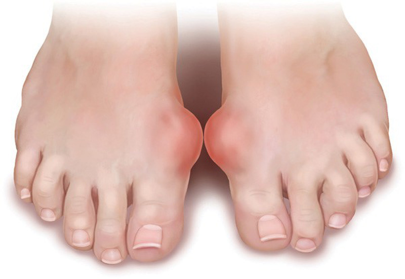 Bài thuốc dân gian trị bệnh gút dứt điểm từ lá tía tô Lá tía tô có công dụng chưa bệnh gút không ngờ