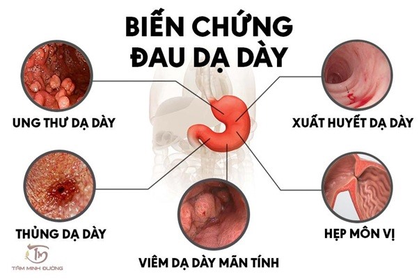 Mắc những triệu chứng này bạn không nên chủ quan, cảnh báo bệnh đau dạ dày
