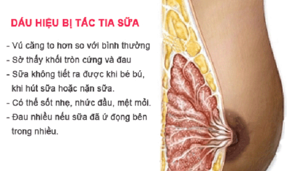 Mách mẹ mẹo hay chữa căng tắc tia sữa tại nhà
