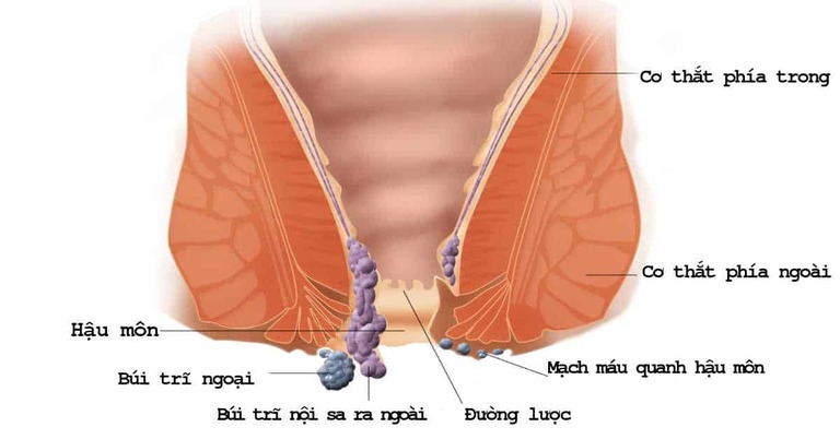 Mẹo chữa bệnh trĩ cho bà bầu, bài thuốc dân gian chữa bệnh trĩ cho bà bầu