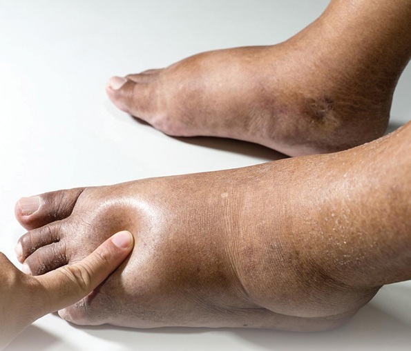 Mẹo giảm phù chân cho bà bầu Mẹo giảm phù chân cho bà bầu