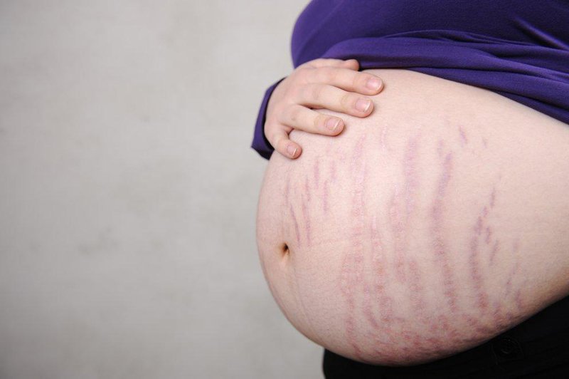 Mẹo trị rạn da cho bà bầu cực hiệu nghiệm từ các 'hot mom' Mẹo trị rạn da cho bà bầu cực hiệu nghiệm từ các 'hot mom'