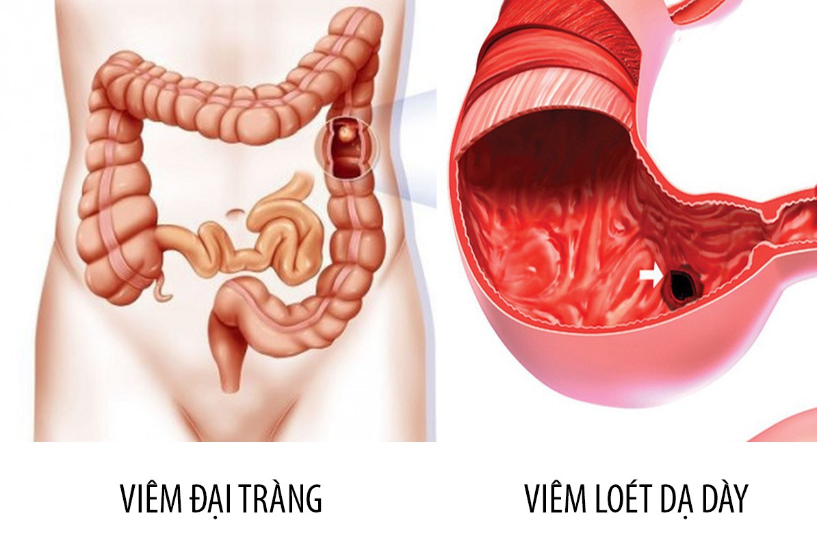 Nhận diện sớm các triệu chứng viêm đại tràng, cần kịp thời xử lý tránh ung thư
