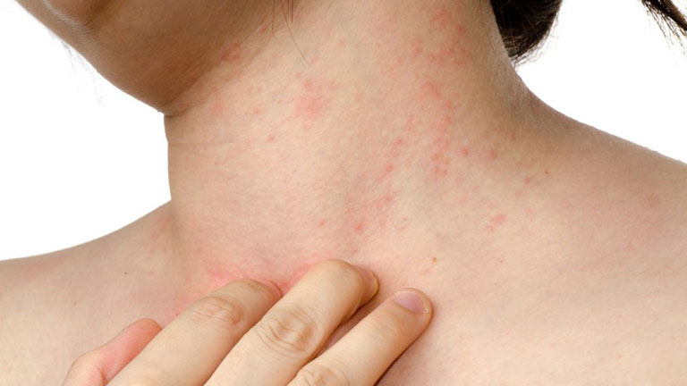 Những bài thuốc chữa bệnh bằng cây lược vàng
