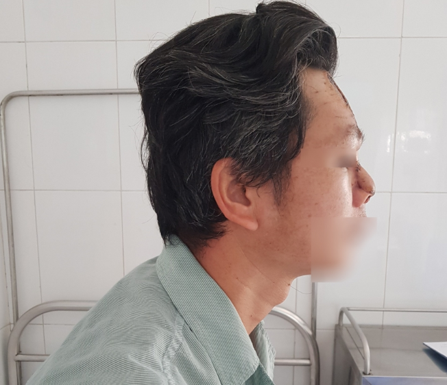 Nốt mụn nhỏ sau 2 tháng hóa ung thư khiến người đàn ông phải cắt bỏ mũi