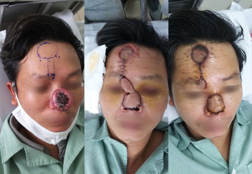 Nốt mụn nhỏ sau 2 tháng hóa ung thư khiến người đàn ông phải cắt bỏ mũi