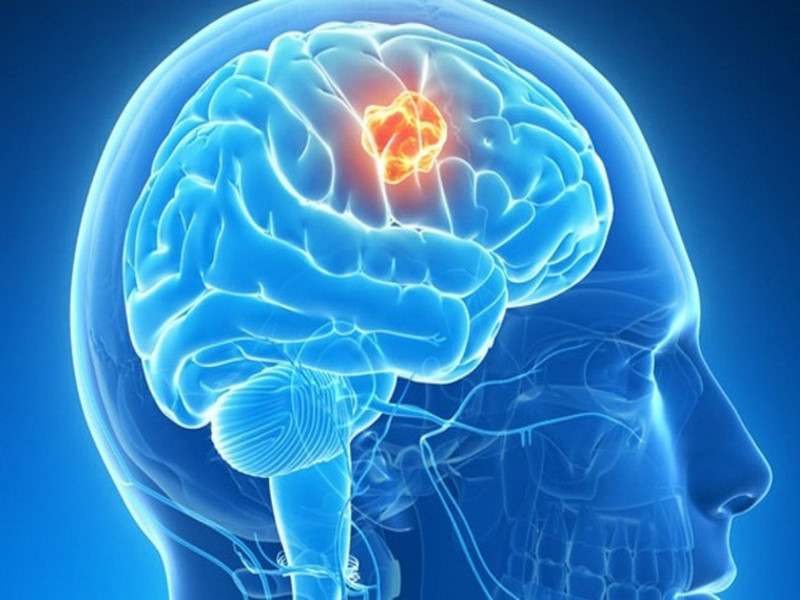 Phân biệt các bệnh đau đầu nguy hiểm qua những dấu hiệu đơn giản Phân biệt các bệnh đau đầu nguy hiểm qua những dấu hiệu đơn giản