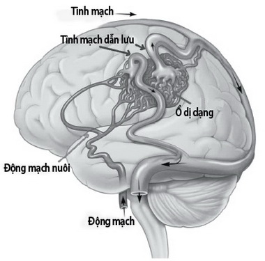 Phân biệt các bệnh đau đầu nguy hiểm qua những dấu hiệu đơn giản Phân biệt các bệnh đau đầu nguy hiểm qua những dấu hiệu đơn giản