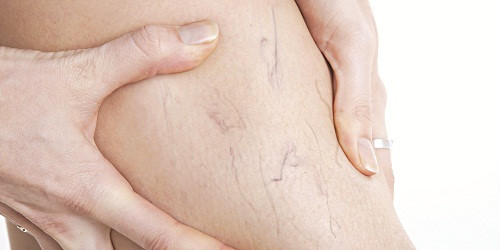 Thuốc Daflon được dùng trong điều trị bệnh suy tĩnh mạch mạn tính Tác dụng thuốc Daflon và một số lưu ý trước khi dùng
