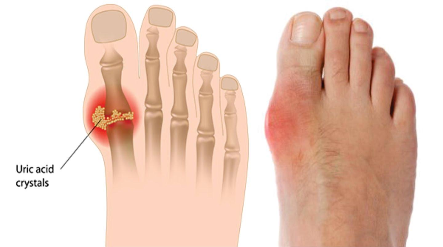 Thuốc Colchicin: Công dụng, liều dùng và những lưu ý trong điều trị bệnh gout