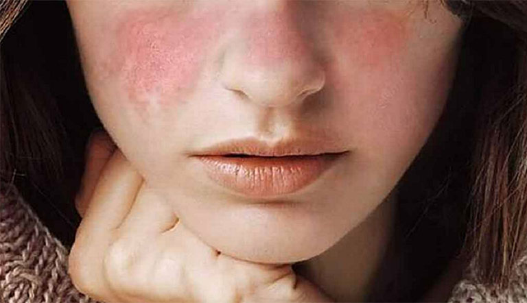 Dùng kem trị sẹo Contractubex có thể bị tác dụng phụ như ngứa, ửng đỏ, nóng rát, nổi mụn,… Thuốc trị sẹo Contractubex: Liều dùng và một số tác dụng phụ