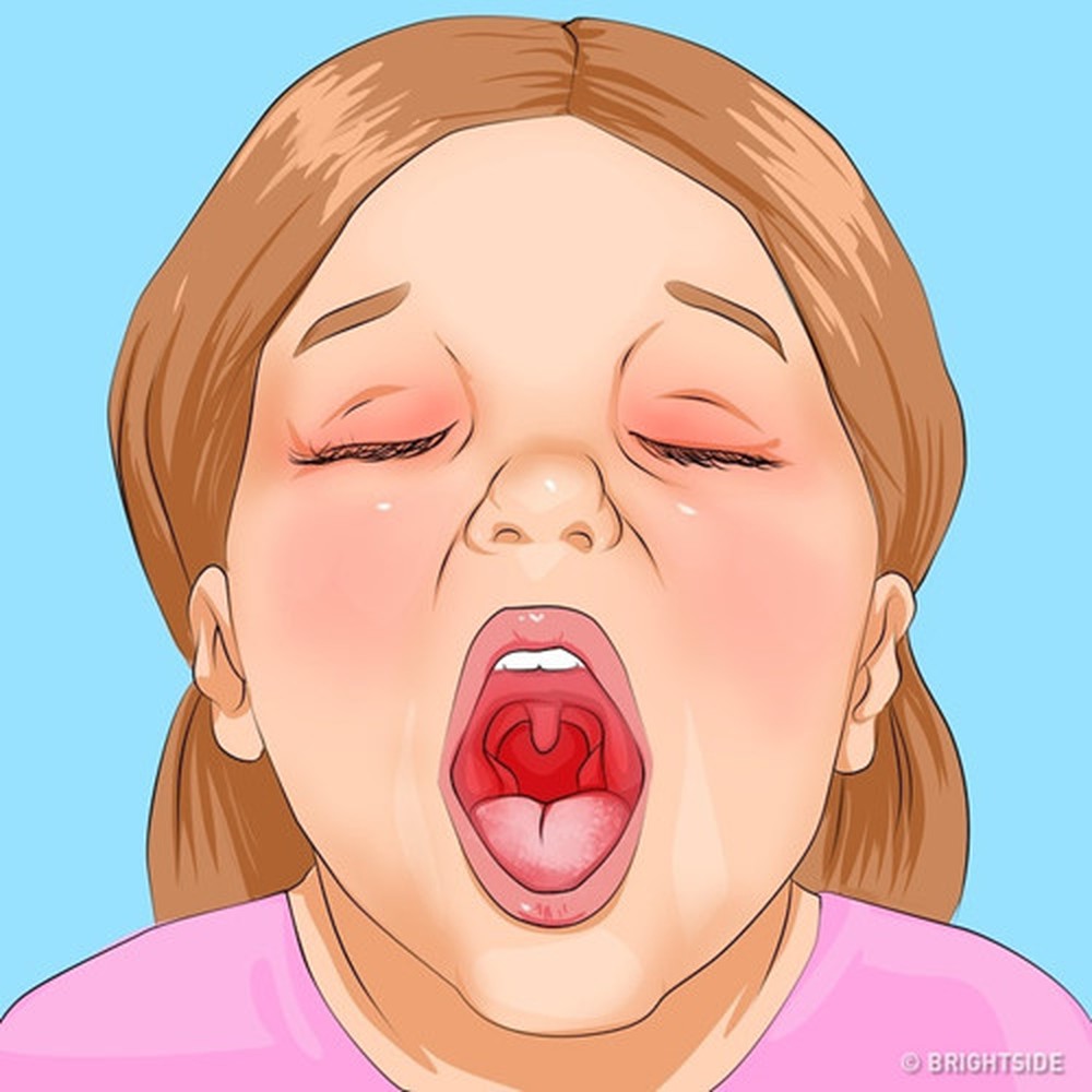 Tiết trời chuyển mùa, phụ huynh nhớ chú ý với 10 triệu chứng cảnh báo bệnh thường gặp ở trẻ
