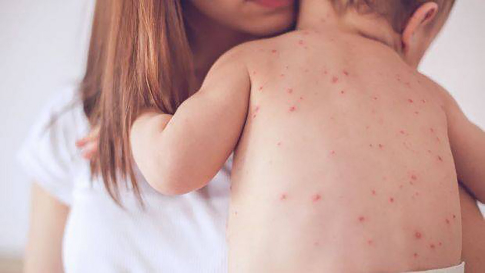Tiết trời chuyển mùa, phụ huynh nhớ chú ý với 10 triệu chứng cảnh báo bệnh thường gặp ở trẻ