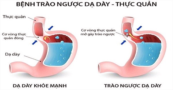 Vi-thuoc-dong-y-chua-benh-trao-nguoc-da-day-hieu-qua