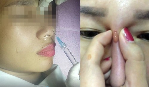 Vụ bé gái 13 tuổi mù mắt vì tiêm filler nâng mũi: Thị lực dần được cải thiện