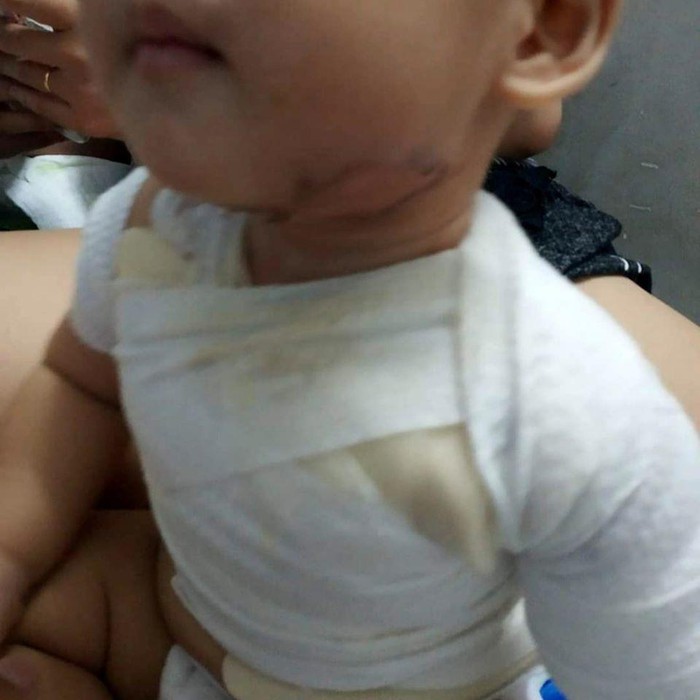 Xót xa bé trai 2 tuổi bỏng nặng vì đổ nước sôi nấu mì