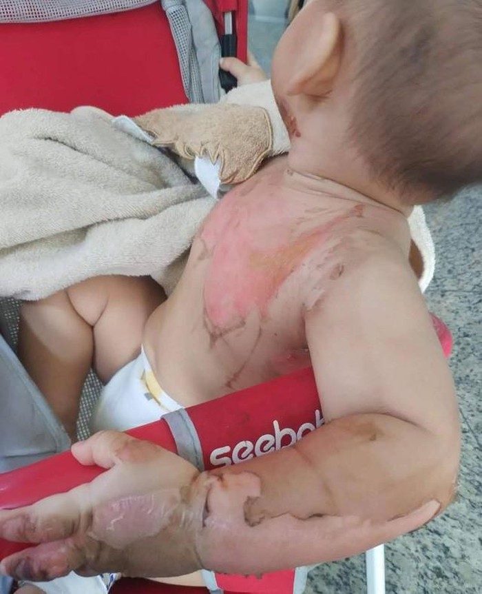 Xót xa bé trai 2 tuổi bỏng nặng vì đổ nước sôi nấu mì Xót xa bé trai 2 tuổi bỏng nặng vì đổ nước sôi nấu mì