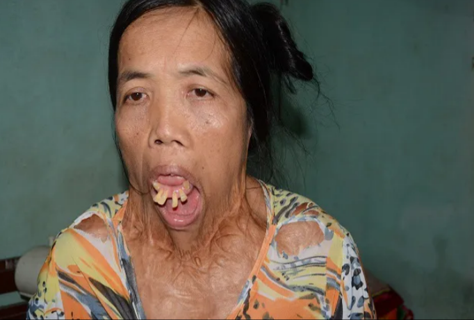 Cảnh đời éo le của người phụ nữ 50 năm không ngậm được miệng, không thể ngoái cổ