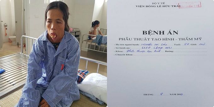 Cảnh đời éo le của người phụ nữ 50 năm không ngậm được miệng, không thể ngoái cổ