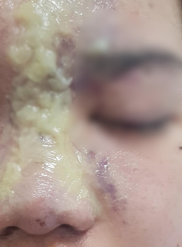 Thiếu nữ 15 tuổi mù vĩnh viễn mắt trái sau khi tiêm filler nâng mũi tại spa gần nhà
