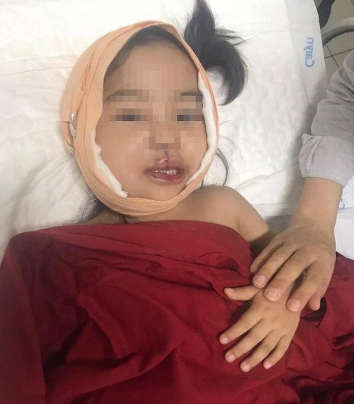 Hành trình tái tạo gương mặt cho bé gái 4 tuổi đeo khối u quái ác bên góc hàm