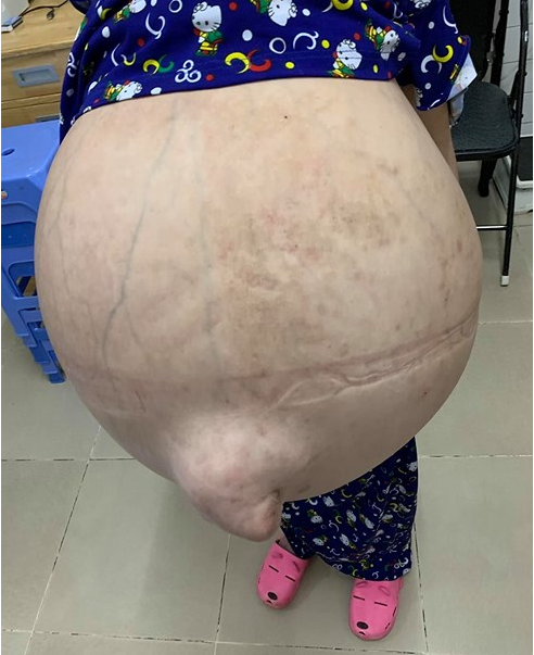 Bác sĩ kể nỗi ám ảnh về cô gái 19 tuổi mang khối u 50 kg, bụng to vượt mặt