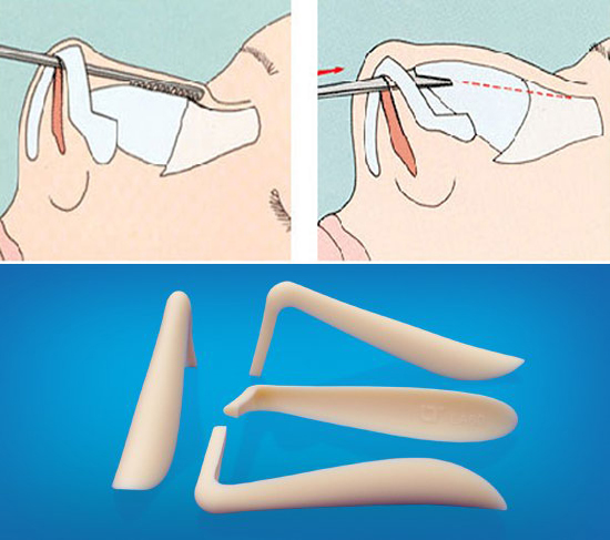 Bị nhiễm trùng, lồi lõm sau nâng mũi bằng sụn silicone