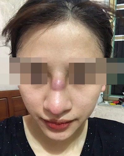 Bị nhiễm trùng, lồi lõm sau nâng mũi bằng sụn silicone