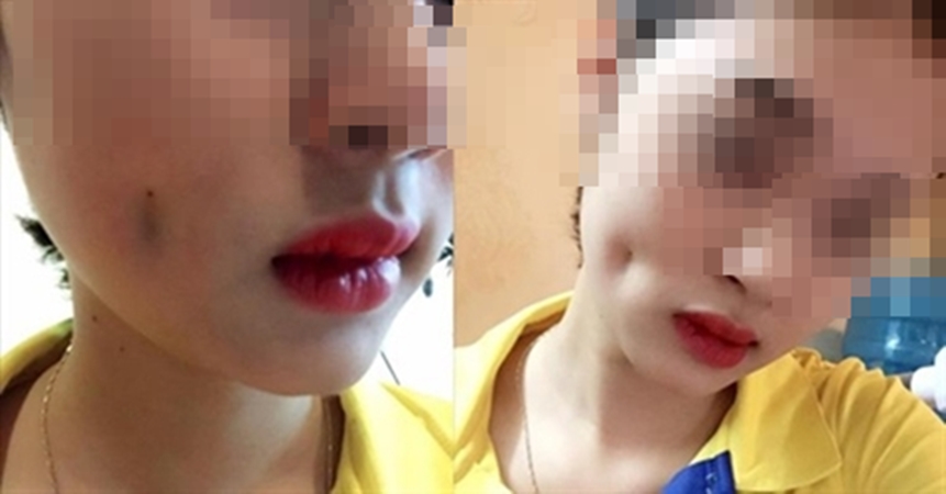Phẫu thuật má lúm để đổi vận, phúc lộc chưa thấy nhưng họa ngay nhãn tiền